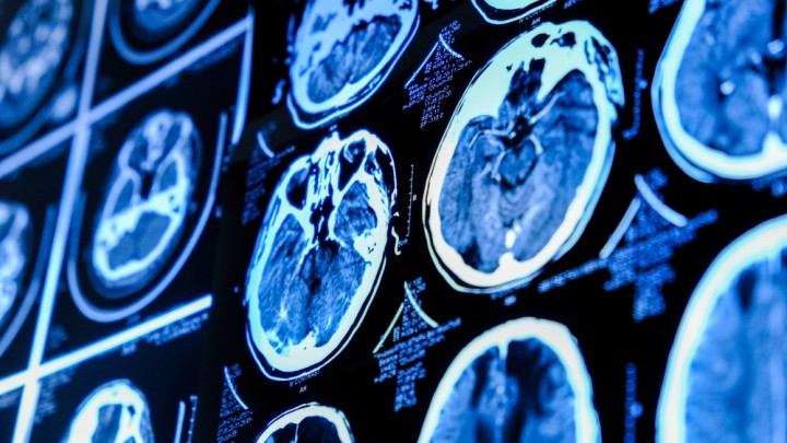 brain TBI