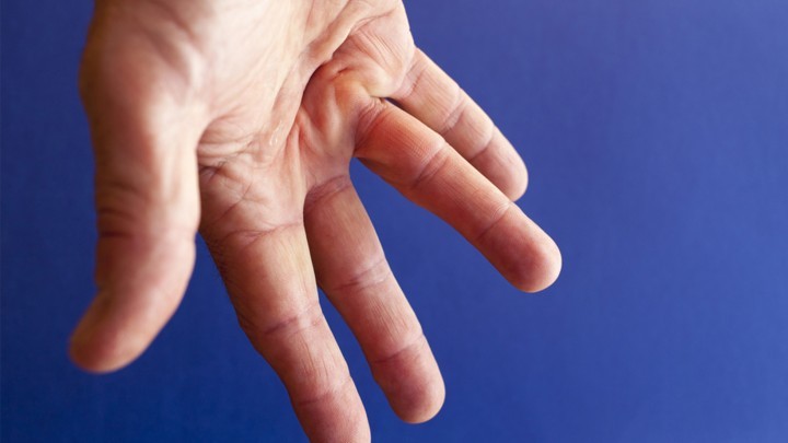 Looking to the future: Trends in Disease - Dupuytren’s Contracture