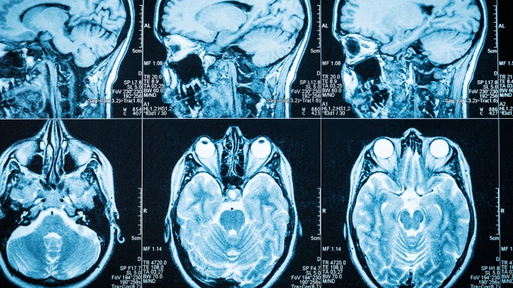 Evaluating prolonged disorders of consciousness (PDOC)