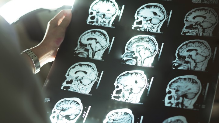 Dementia and TBI - An unconventional couple?