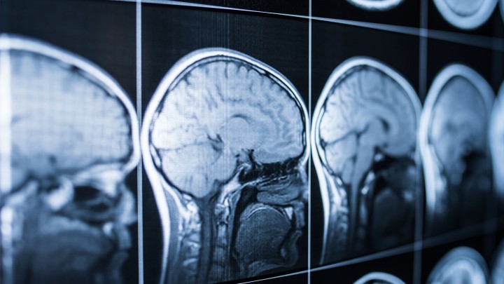 Divisibility of brain injuries